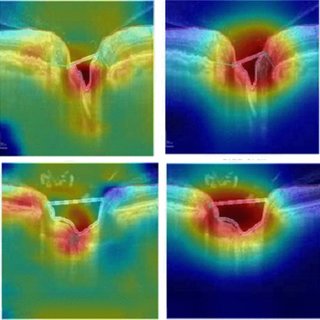 A graphic displaying GradCAM heatmaps for VGG16, ResNet18, and a proposed deep learning model (left to right), derived from segmented OCT images of glaucomatous eyes, highlighting areas of focus in the images for each model.